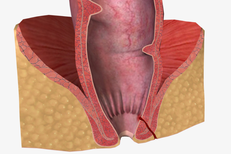 Fistula in Ano