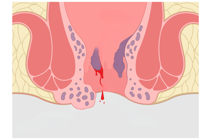 Peri anal-Anal abscess