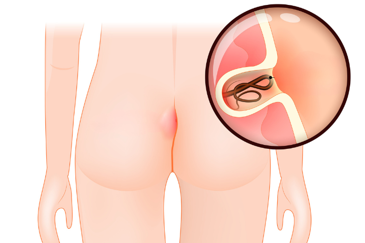 Pilonidal sinus