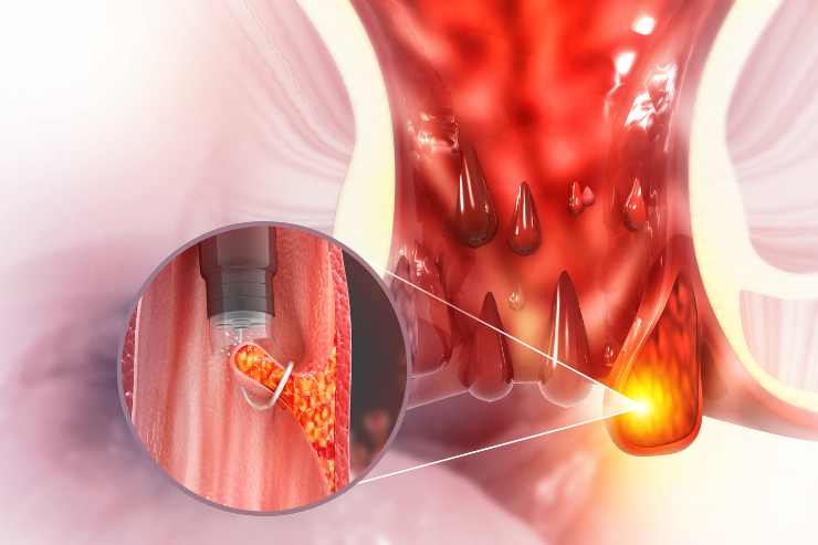 Surgery for Haemorrhoids